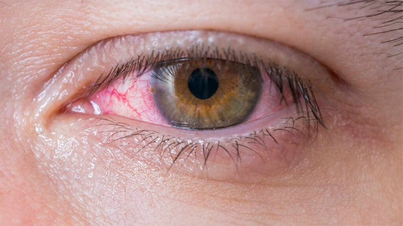 Vermelhidão ocular
