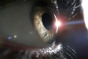 Tratamento Cirurgia Lasik