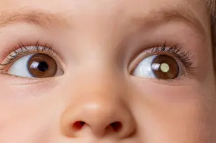 Retinoblastoma: o que é, sintomas e tratamento