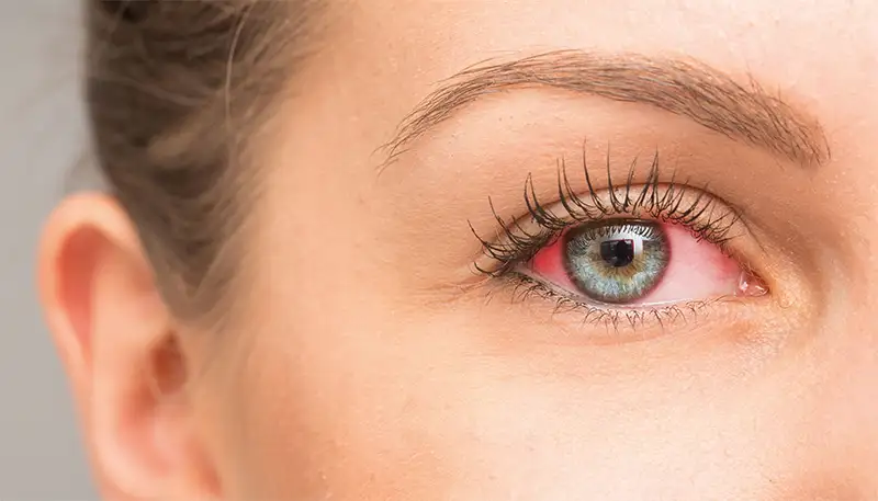 Olhos Vermelhos ao Usar Maquilhagem? Causas e Soluções